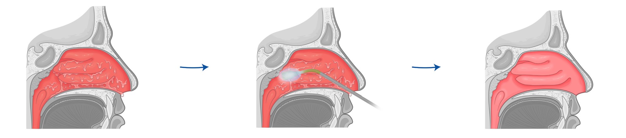 Cryosurgical ENT procedure in the nasal cavity